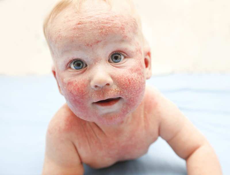 Little baby with dermatitis on face